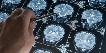 Alzheimer teşhisinde kan testi devrimi