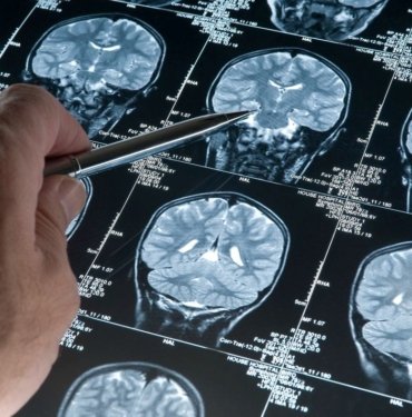 Alzheimer teşhisinde kan testi devrimi
