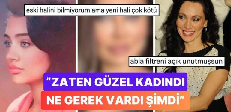 Estetik Yaptırma Konusunda Dur Durak Bilmeyen Yerli Angelina Jolie’miz Umut Akyürek Son Halini Paylaştı