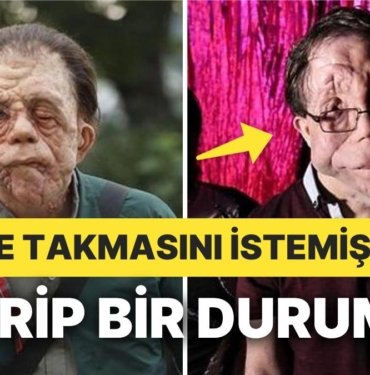 Scarlet Johannson ile Çalışmıştı: Şekil Bozukluğu Sendromundan Muzdarip İngiliz Oyuncu Sonunda Veryansın Etti
