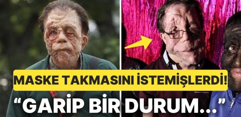 Scarlet Johannson ile Çalışmıştı: Şekil Bozukluğu Sendromundan Muzdarip İngiliz Oyuncu Sonunda Veryansın Etti