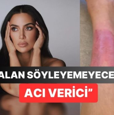 Kim Kardashian Hesabında Bacağında Oluşan Uzun Süreli Yaraları Paylaştı: Takipçileri Şaşkına Döndü