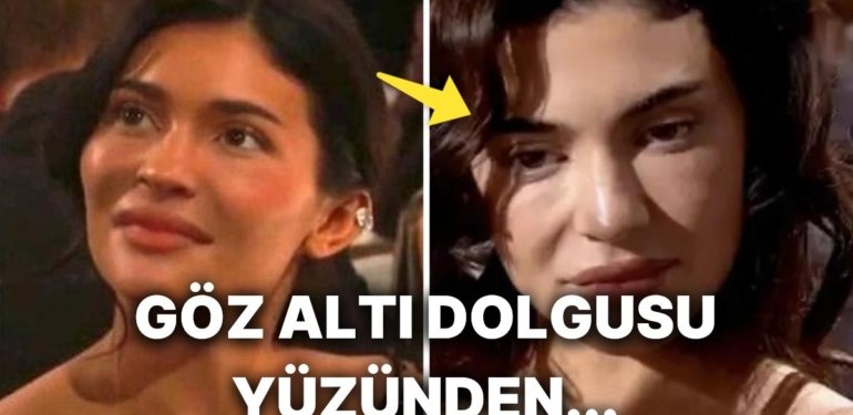 Kylie Jenner’ın Suratındaki Şişkinlik ve Yaşlı Görünümün Sebebini Uzman Doktorlar Açıkladı