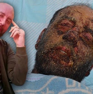 Covid-19’dan sonra milyonda 2 görülen hastalığa yakalandı: Yüzü tanınmaz hale geldi