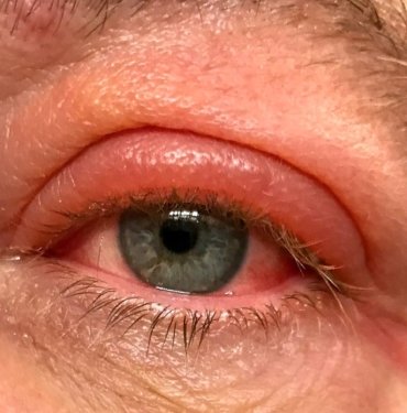 Sarhoşken yüzüstü uyudu, kör uyandı!