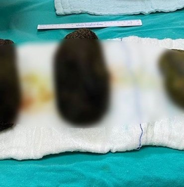 Türkiye’de yaşandı karın ağrısıyla gitti midesinden 2 kilo saç çıktı