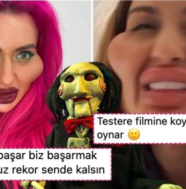 Dünyanın En Büyük Elmacık Kemiklerine Sahip Anastasia Ameliyat Olmak İçin Bir Kez Daha İstanbul’a Geldi!