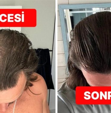 Sekiz Ay Boyunca Uyguladığım Doğal Yöntemlerle Saç Dökülmesinin Önüne Nasıl Geçtim?