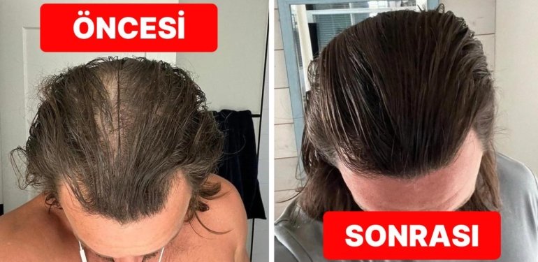 Sekiz Ay Boyunca Uyguladığım Doğal Yöntemlerle Saç Dökülmesinin Önüne Nasıl Geçtim?