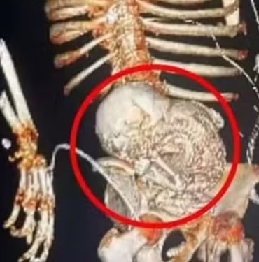 Ölü fetüsü 56 yıl boyunca karnında taşıdı, çıkarılırken öldü