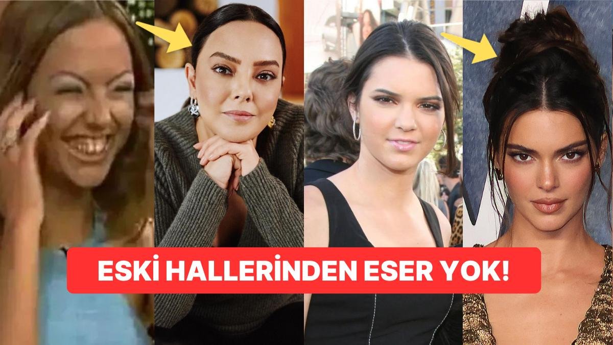 O Eski Halinden Eser Yok Şimdi! Yaptırdıkları Estetikler ile Bambaşka Birine Dönüşen Ünlü İsimler