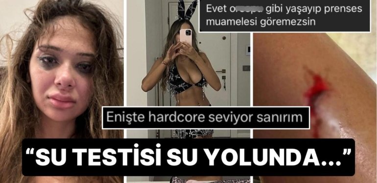 Eski Sevgilisinden Şiddet Gören OnlyFans Fenomeni Merve Taşkın’a Gelen İnsanlık Dışı Yorumlar!