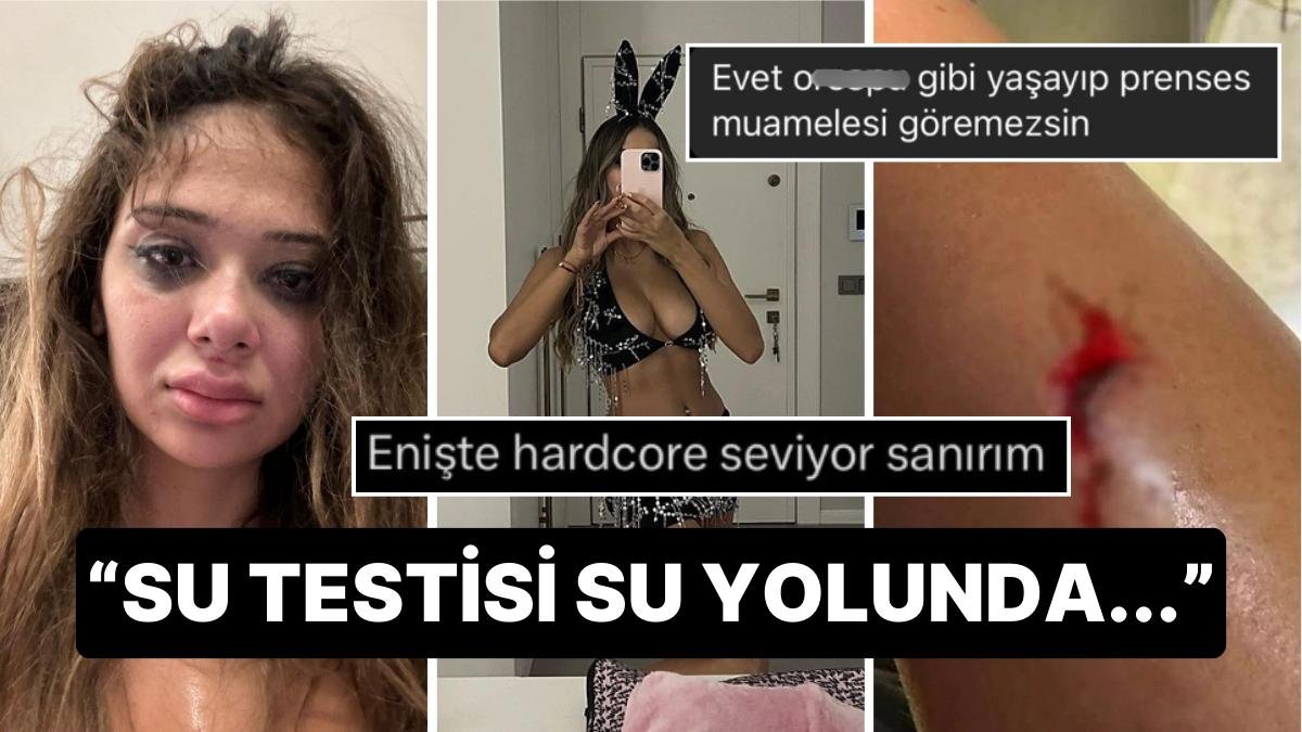 Eski Sevgilisinden Şiddet Gören OnlyFans Fenomeni Merve Taşkın’a Gelen İnsanlık Dışı Yorumlar!
