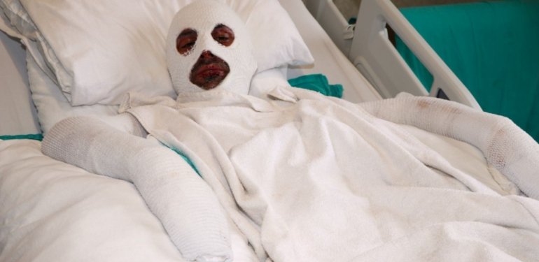 Gazı açıp sohbete daldı, çakmağı çakınca hastanelik oldu