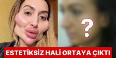 Dünyanın En Büyük Elmacık Kemiklerine Sahip Anastasia Pokreshchuk’un Estetiksiz Hali Görenleri Şoke Etti!