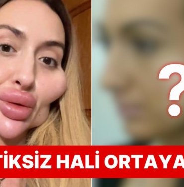 Dünyanın En Büyük Elmacık Kemiklerine Sahip Anastasia Pokreshchuk’un Estetiksiz Hali Görenleri Şoke Etti!