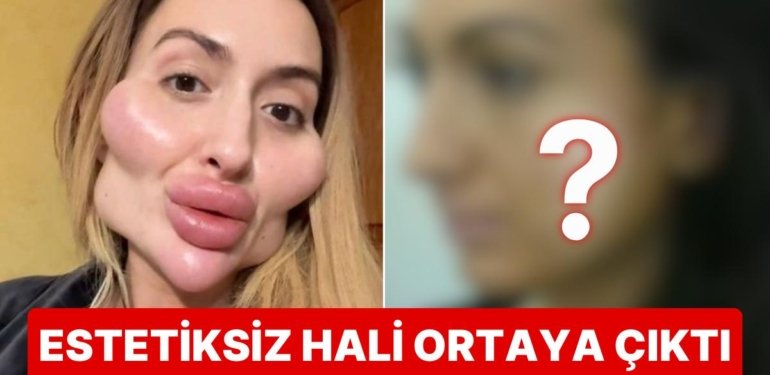 Dünyanın En Büyük Elmacık Kemiklerine Sahip Anastasia Pokreshchuk’un Estetiksiz Hali Görenleri Şoke Etti!