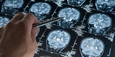 Travmatik olaylar Alzheimer riskini artırıyor olabilir
