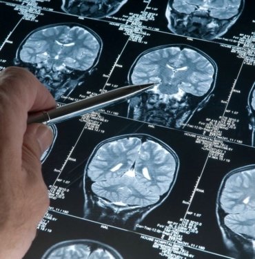 Travmatik olaylar Alzheimer riskini artırıyor olabilir