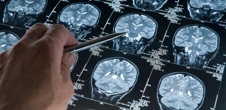 Travmatik olaylar Alzheimer riskini artırıyor olabilir